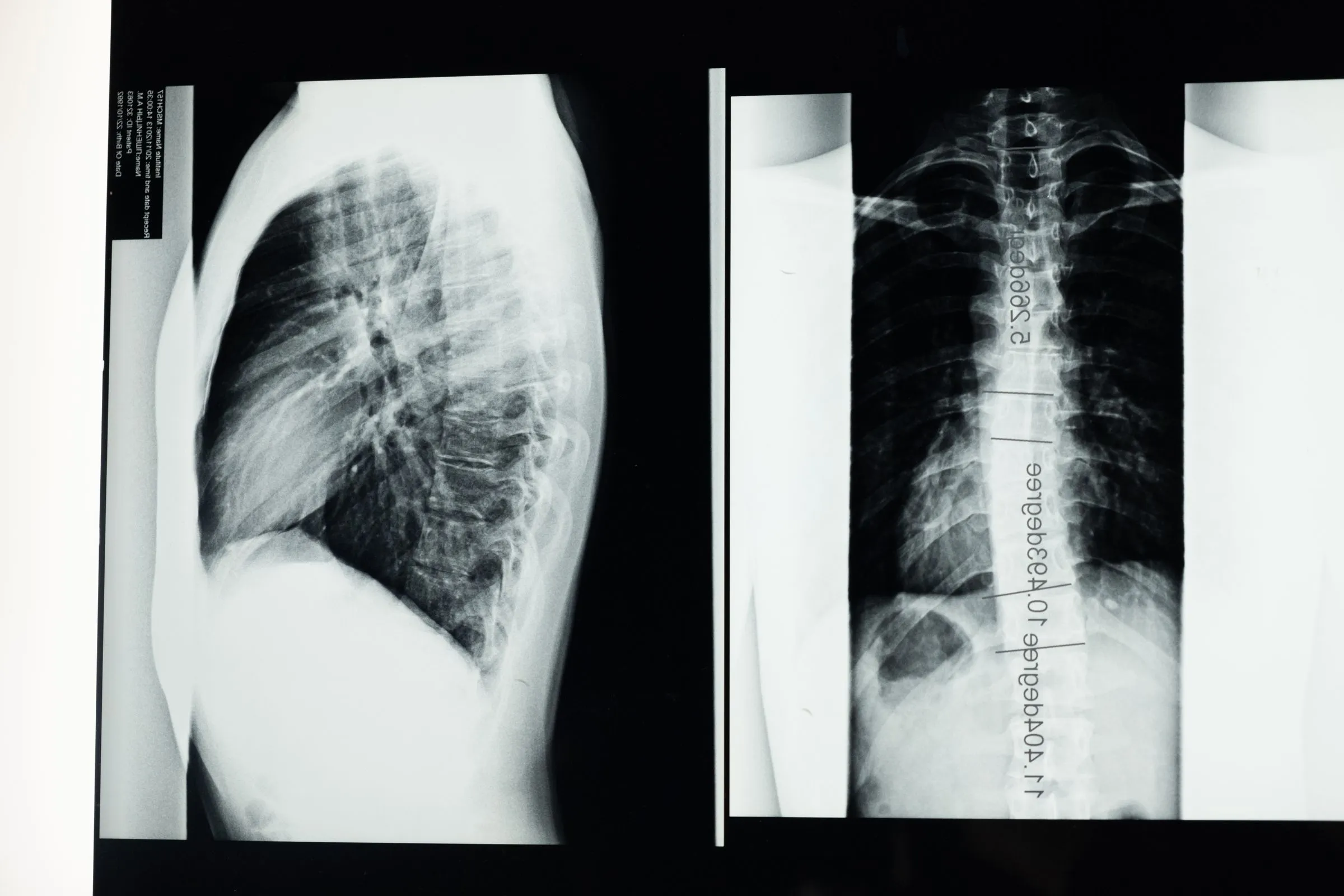 Radiografia de coluna vertebral